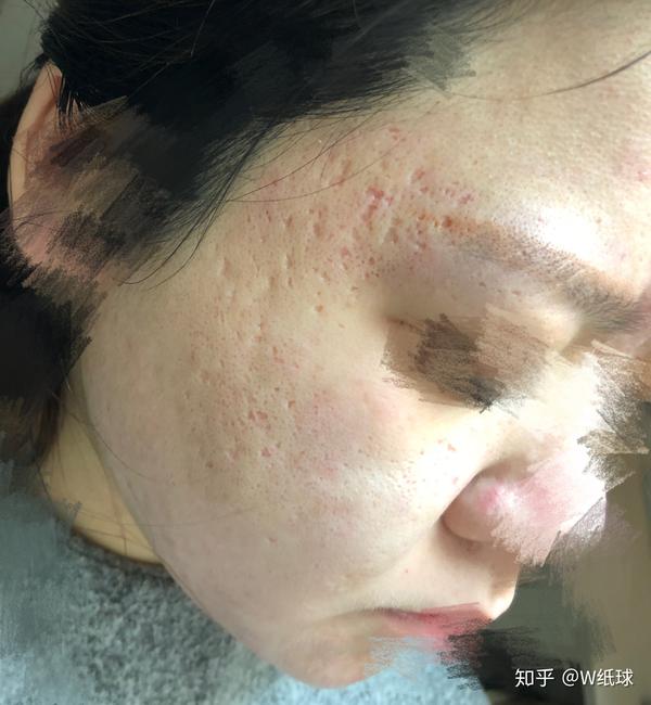 最新plasma去痘坑,最新Plasma技术，重塑肌肤，告别痘坑