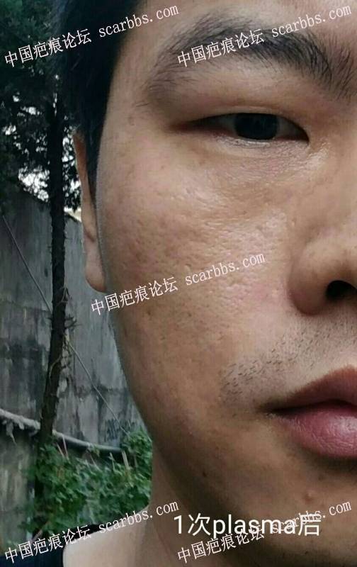 最新plasma去痘坑,最新Plasma技术,重塑肌肤,告别痘坑