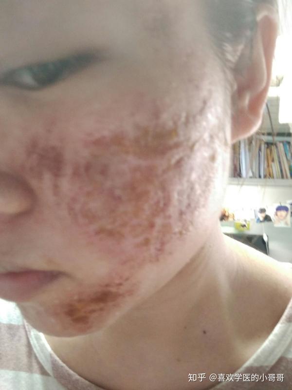 最新plasma去痘坑,最新Plasma技术,重塑肌肤,告别痘坑