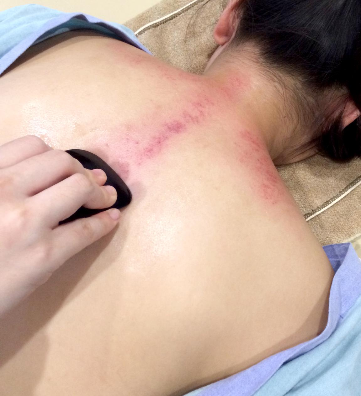 刮痧最新趋势，传统疗法的现代演绎与运用