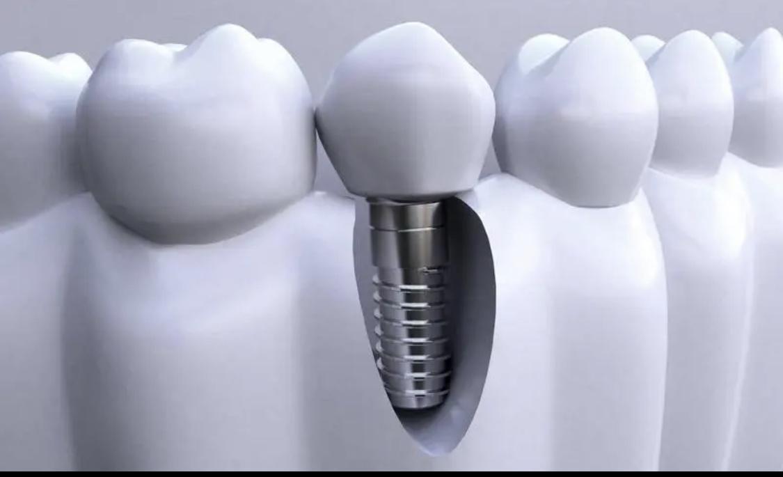 最新牙冠，微笑中的力量，人生转折点之齿间重生