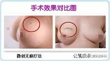乳腺微创手术价格及爱的陪伴之旅