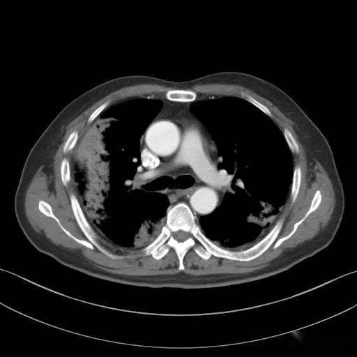 肺炎最新,肺炎最新📣🚨，你需要知道的一切都在这里！