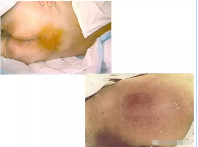 褥疮最新分期全面指南，了解与治疗策略
