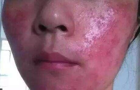 激素脸最新科技重塑肌肤之美,探索最新科技与肌肤重塑的奇迹之旅