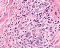 淋病最新论述概述