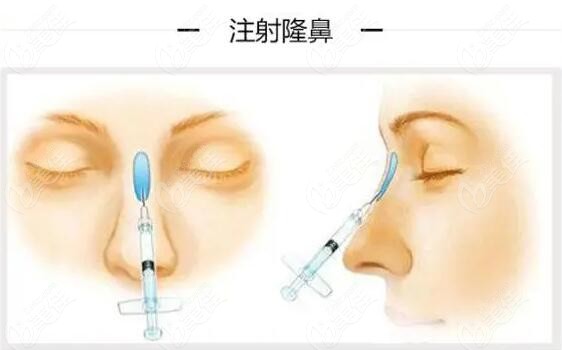 最新隆鼻技术，探索自然美景与内心平静的旅程体验
