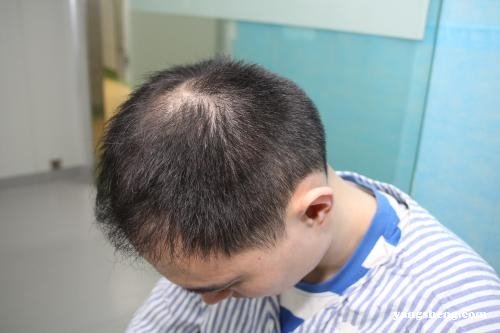 最新植发费用，科技重塑美丽，植发改变人生之路