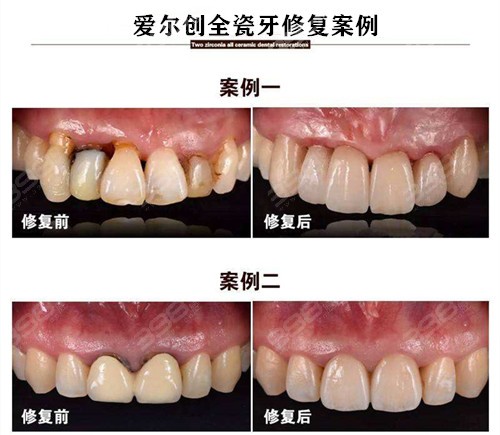 全瓷牙的价格之旅，探寻微笑密码的旅程