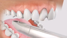 牙齿再生最新技术,重拾笑容,从齿开始新人生